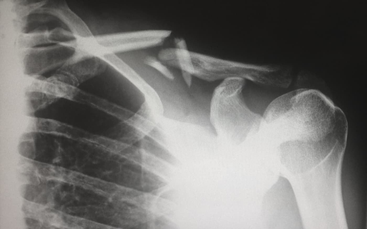Shoulder X-ray under review